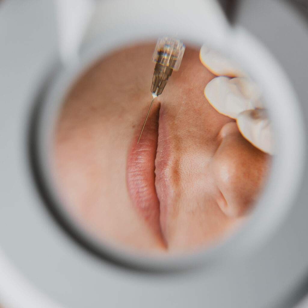 Medicina estética con ácido hialurónico en Valdemoro